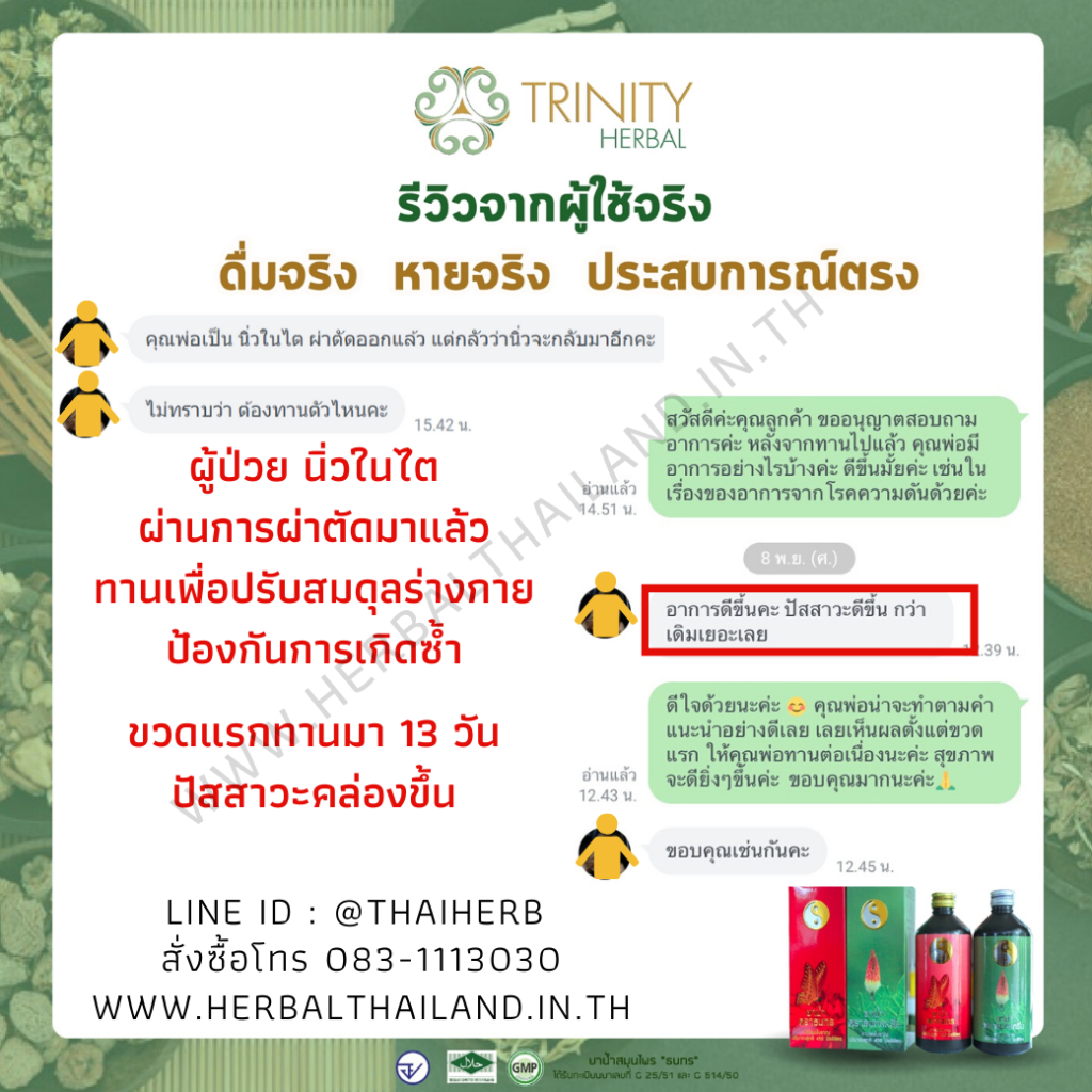 รีวิว3 นิ่วในไต